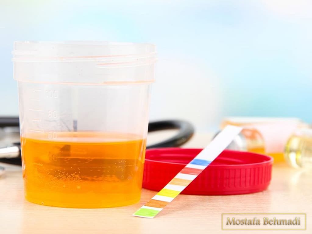 آزمایش ادرار ازمایش ادرار و آنالیز آن