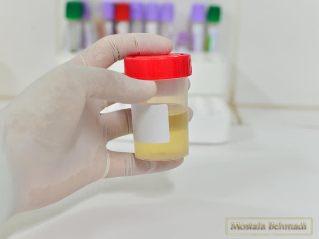 تفسیر ازمایش ادرار تفسیر ازمایش ادرار