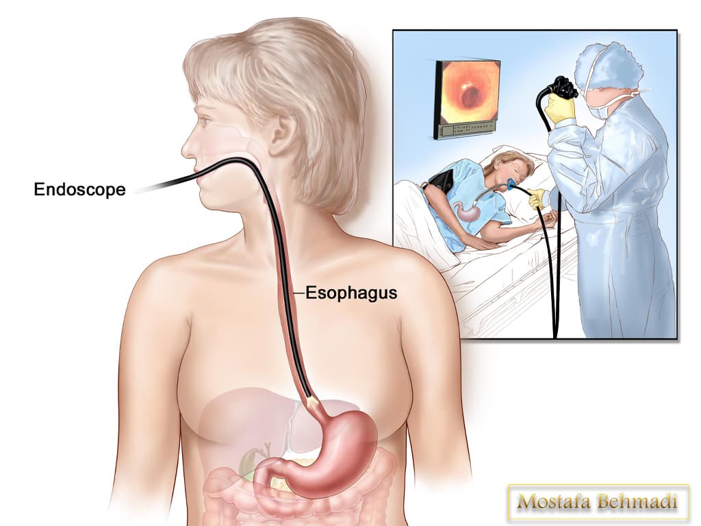 Биопсия пищевода. Проведение гастроскопии желудка. Эндоскоп для гастроскопии.