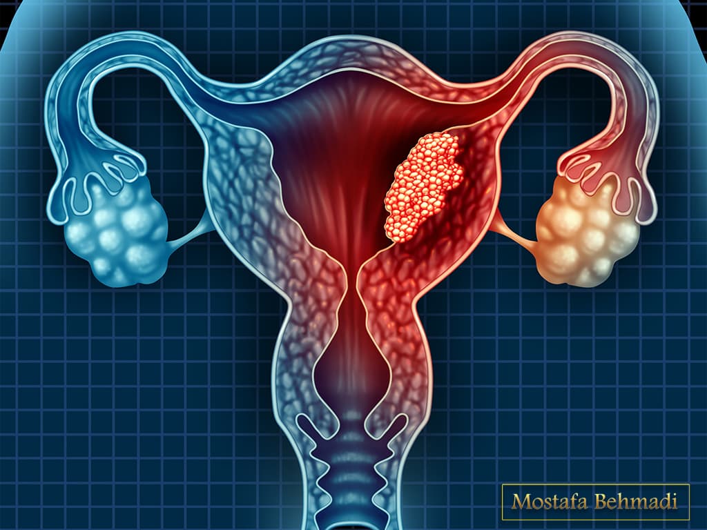 کیست تخمدان