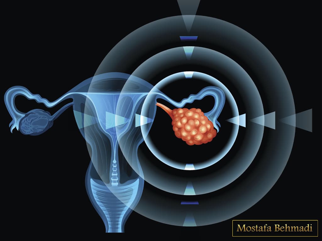 علائم سرطات تخمدان