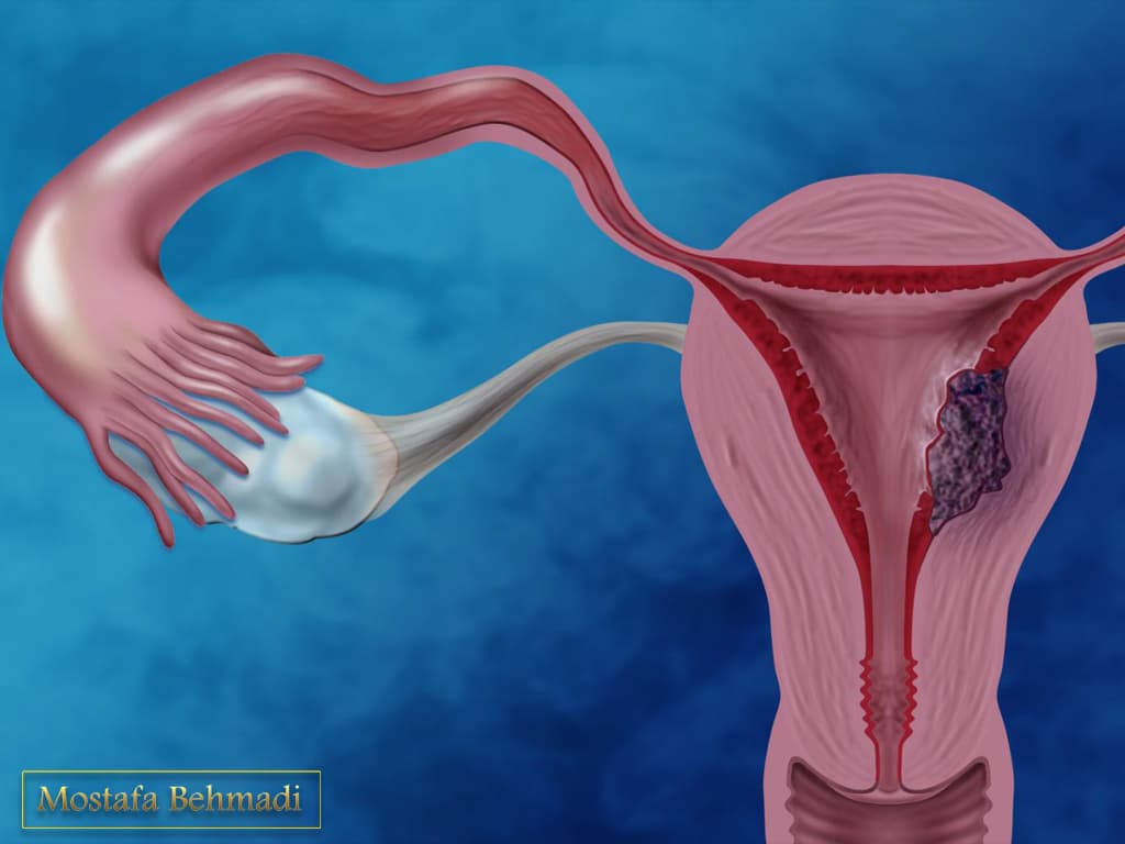 سرطان تخمدان