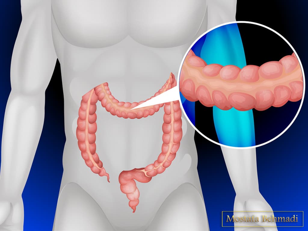 سرطان روده بزرگ