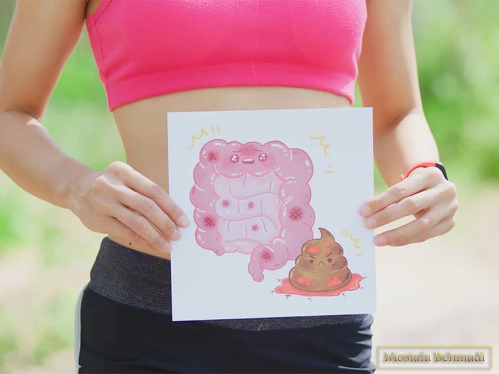  سرطان روده بزرگ