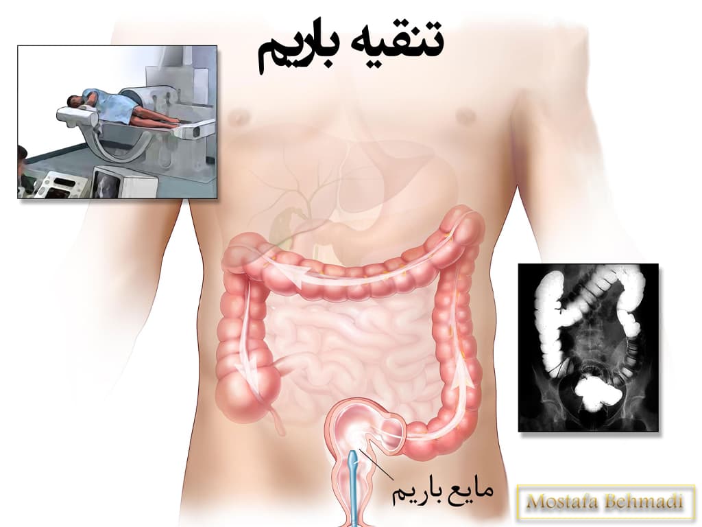 تشخیص سرطان روده