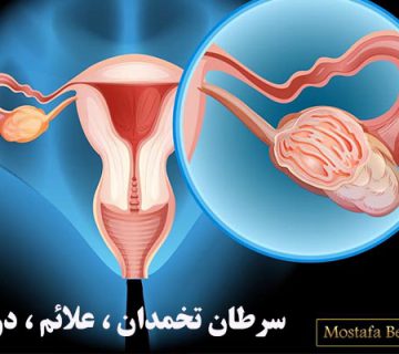 سرطان تخمدان ، علائم ، درمان