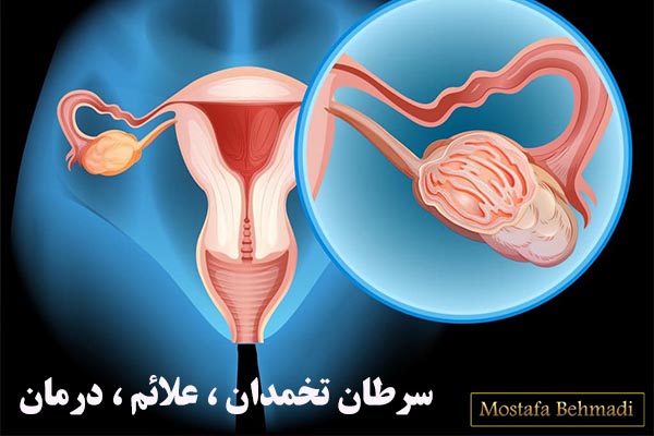 سرطان تخمدان ، علائم ، درمان