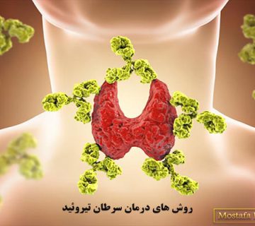 روش های درمان سرطان تیروئید