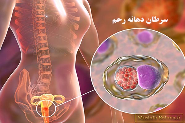 سرطان دهانه رحم ، همه چیز در مورد آن