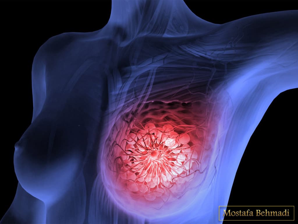 کیست سینه کیست سینه