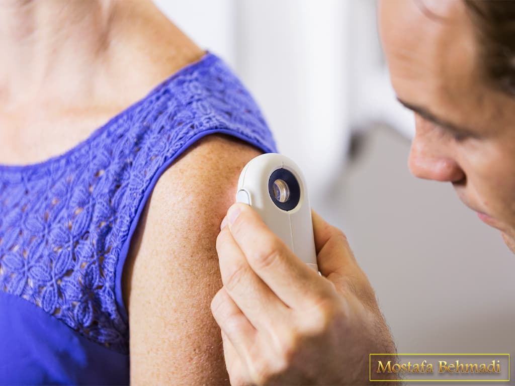 درمان ملانوما
