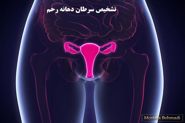 تشخیص سرطان دهانه رحم