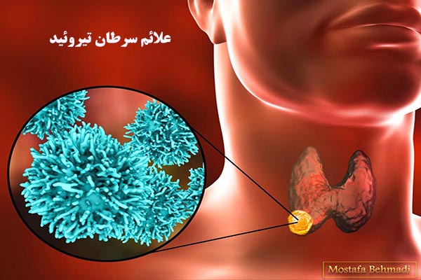 علائم سرطان تیروئید