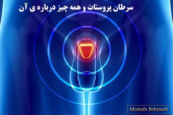 سرطان پروستات و همه چیز درباره ی آن