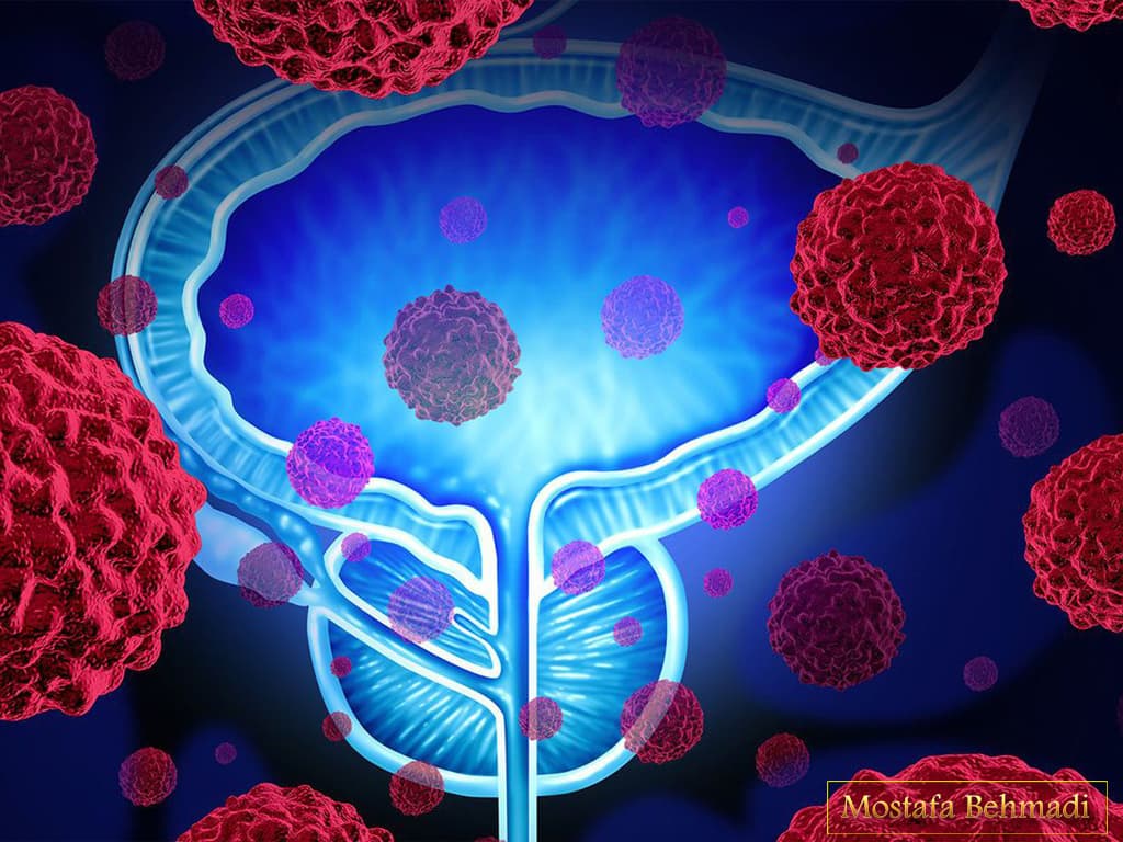 علائم سرطان پروستات