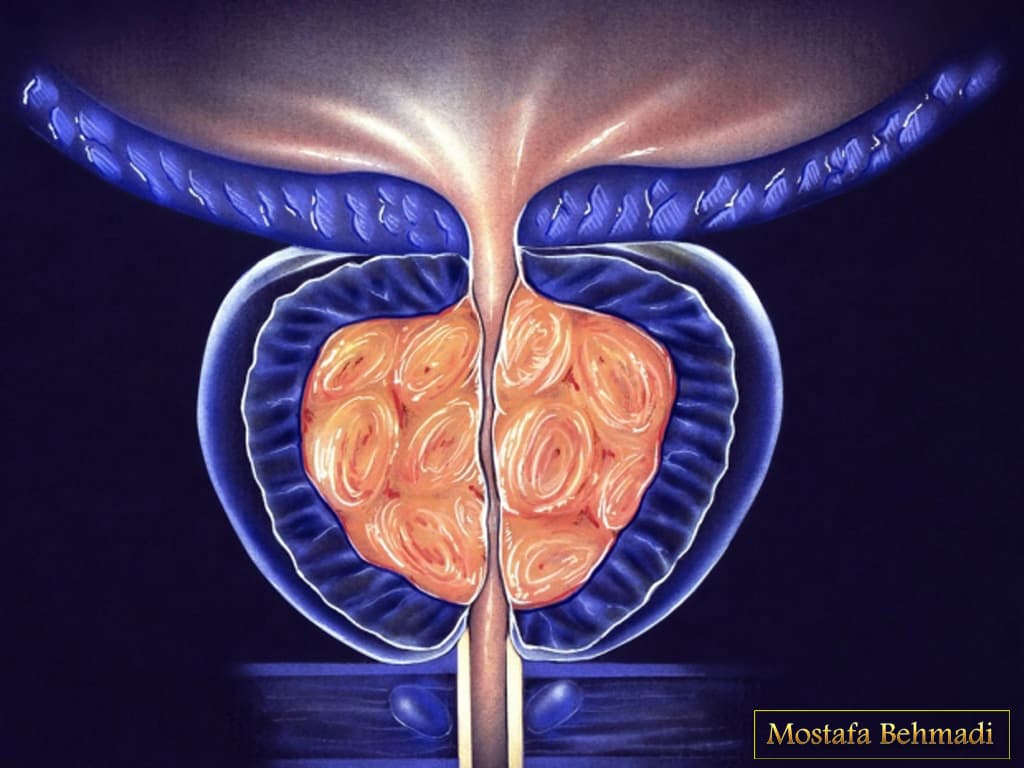 سرطان پروستات خوش خیم
