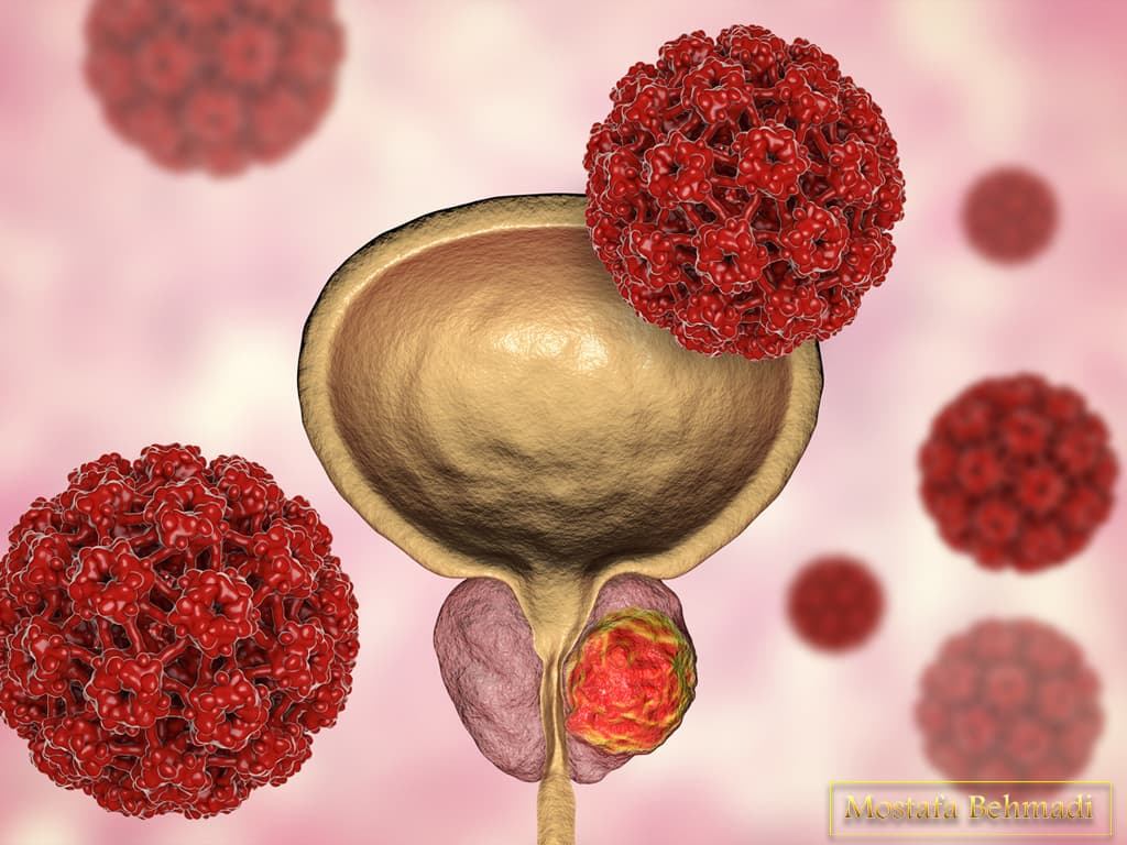 تشخیص سرطان پروستات تشخیص سرطان پروستات