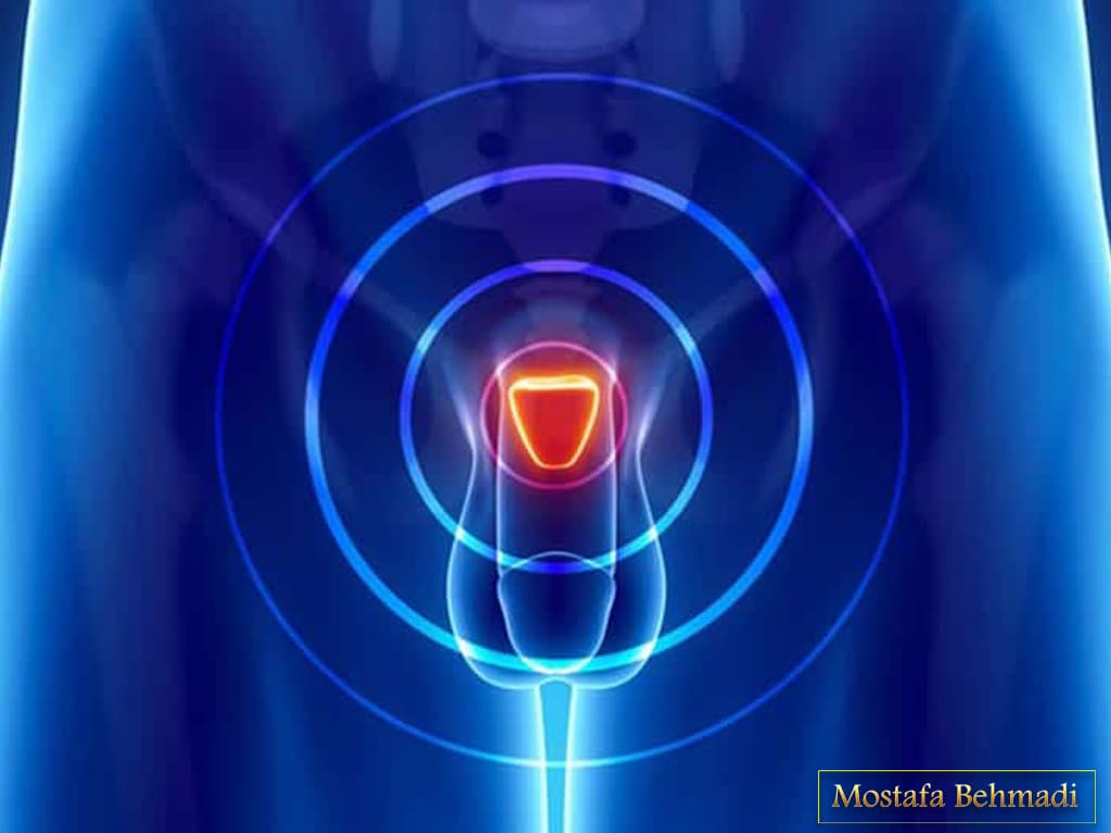 نشانه های سرطان پروستات