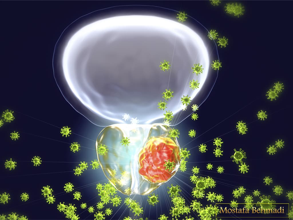 سرطان پروستات و همه چیز در مورد آن