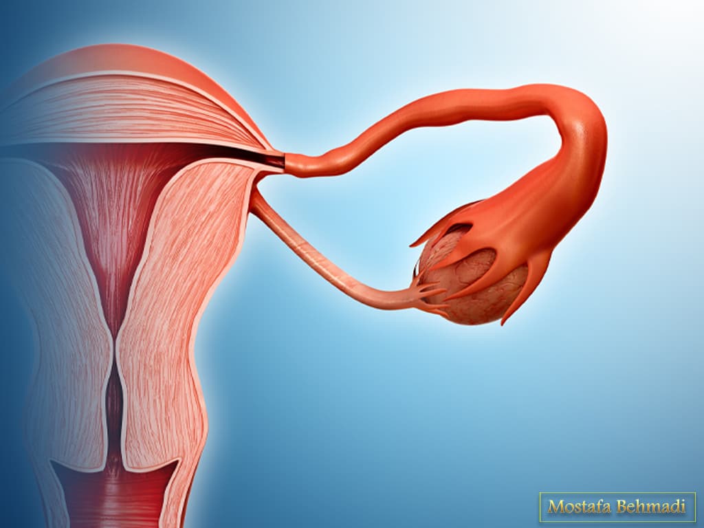 تشخیص سرطان تخمدان تشخیص سرطان تخمدان