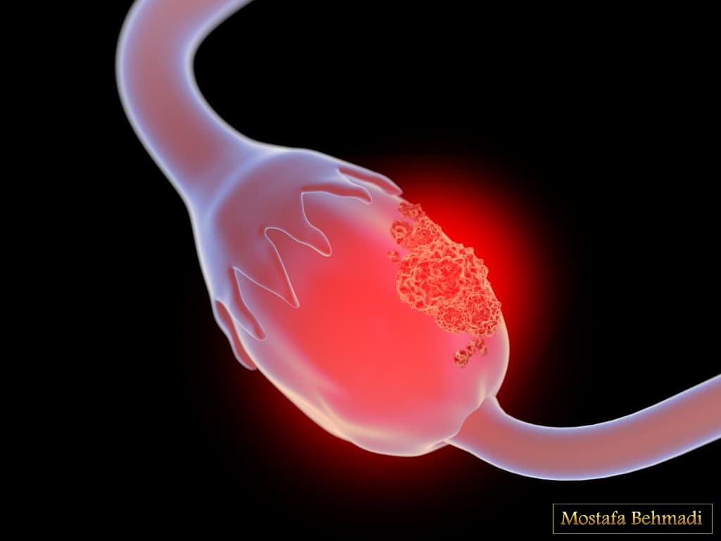 نشانه های سرطان تخمدان نشانه های سرطان تخمدان