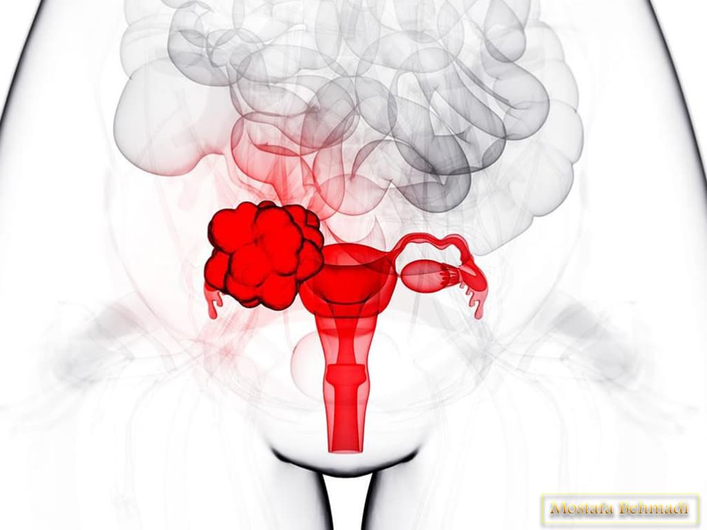 علائم سرطان تخمدان سرطان تخمدان