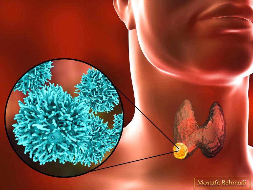 سرطان تیروئید