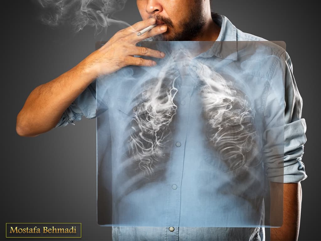 علائم سرطان ریه علائم سرطان ریه