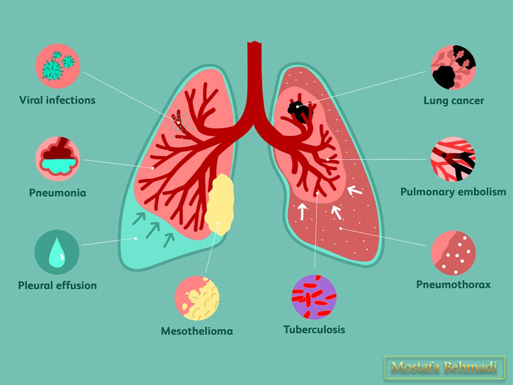 علائم سرطان ریه علائم سرطان ریه