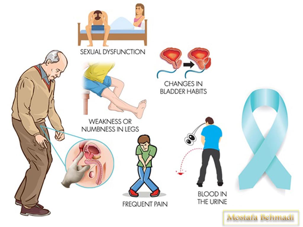 علائم سرطان پروستات نشانه های پروستات