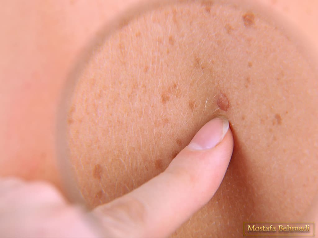 نشانه های سرطان پوست