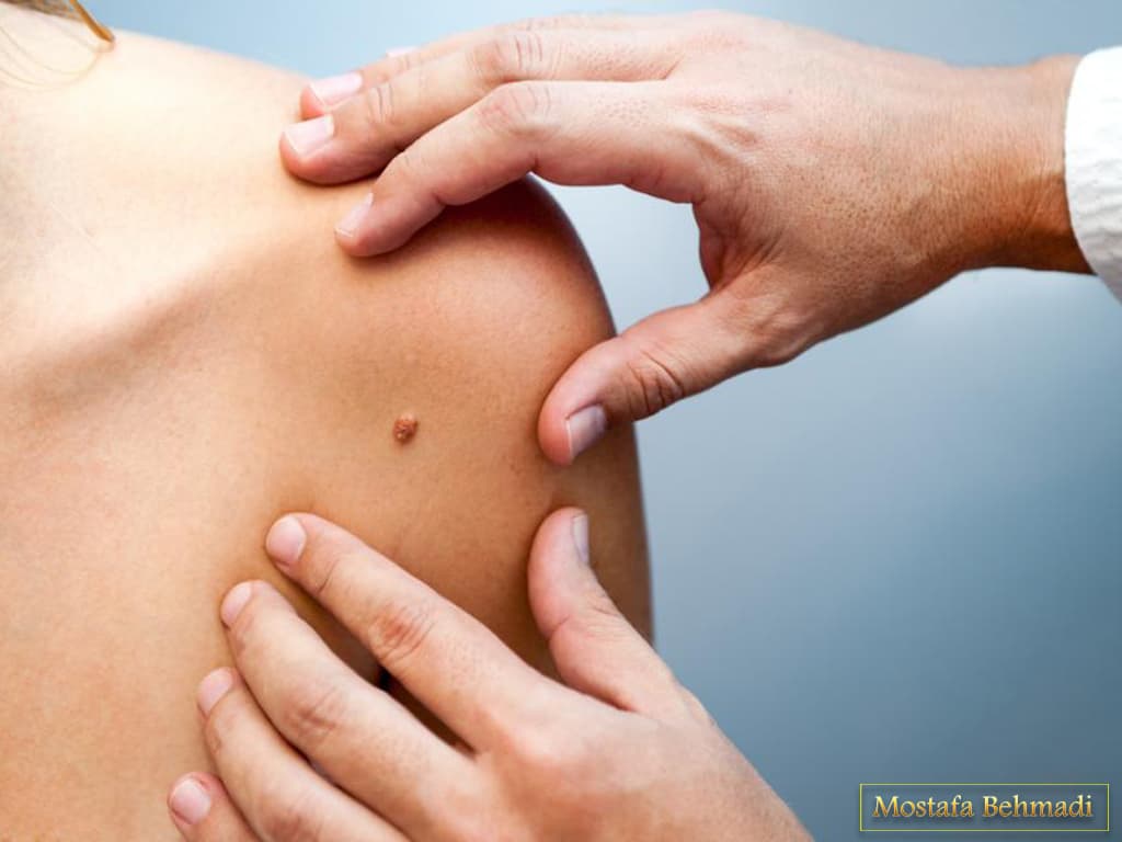 تشخیص سرطان پوست