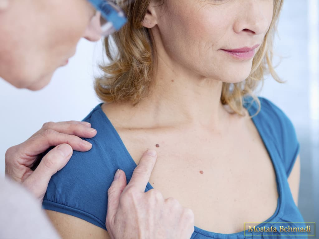 علائم سرطان پوست