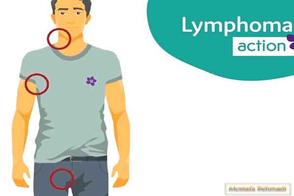 علائم سرطان لنفوم