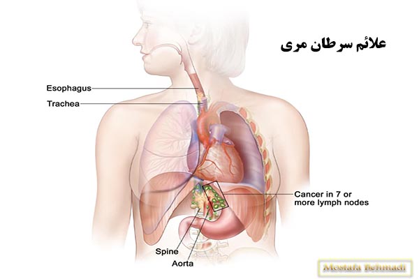 علائم سرطان مری