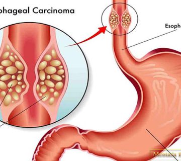 علائم سرطان معده