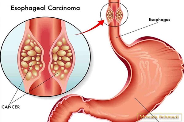 علائم سرطان معده
