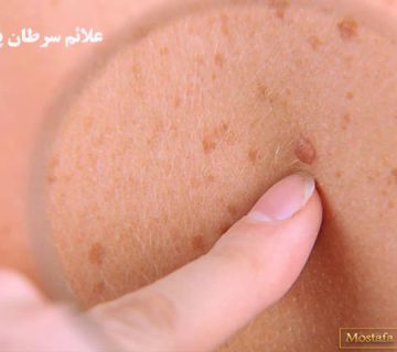 علائم سرطان پوست