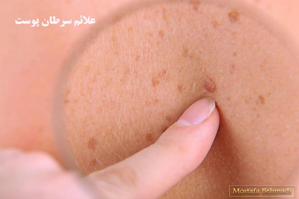 علائم سرطان پوست