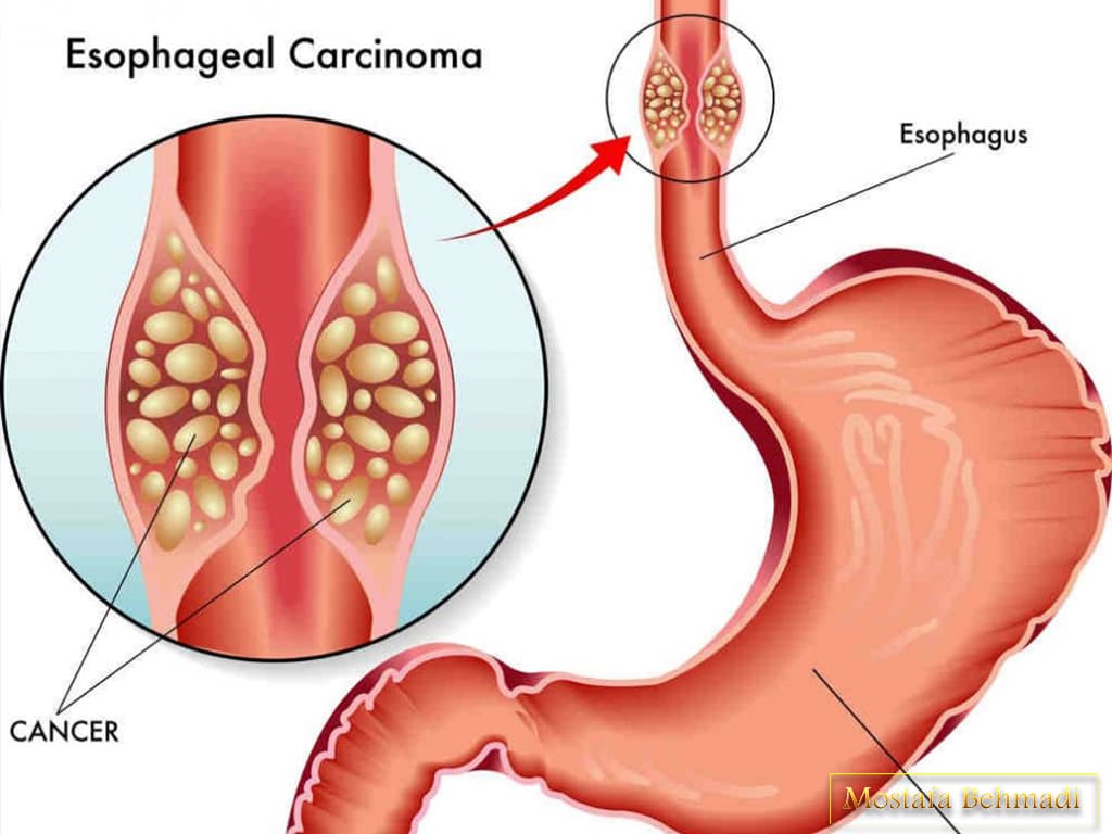 درمان سرطان معده درمان سرطان معده