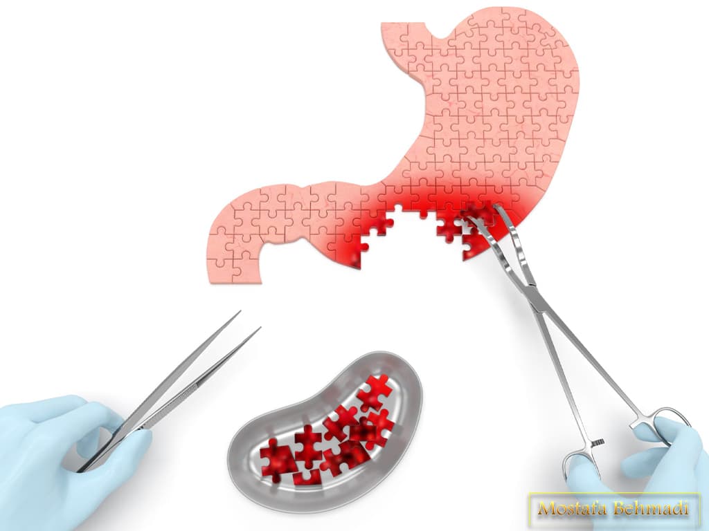 سرطان معده سرطان معده