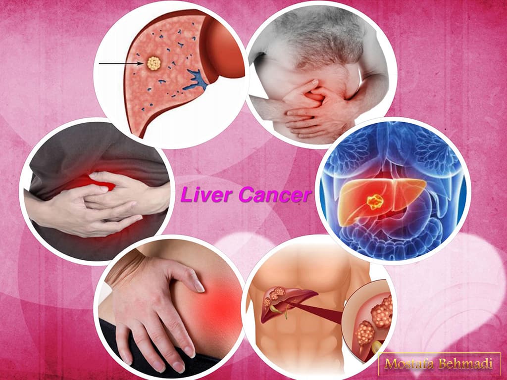 سرطان کبد و درمان آن