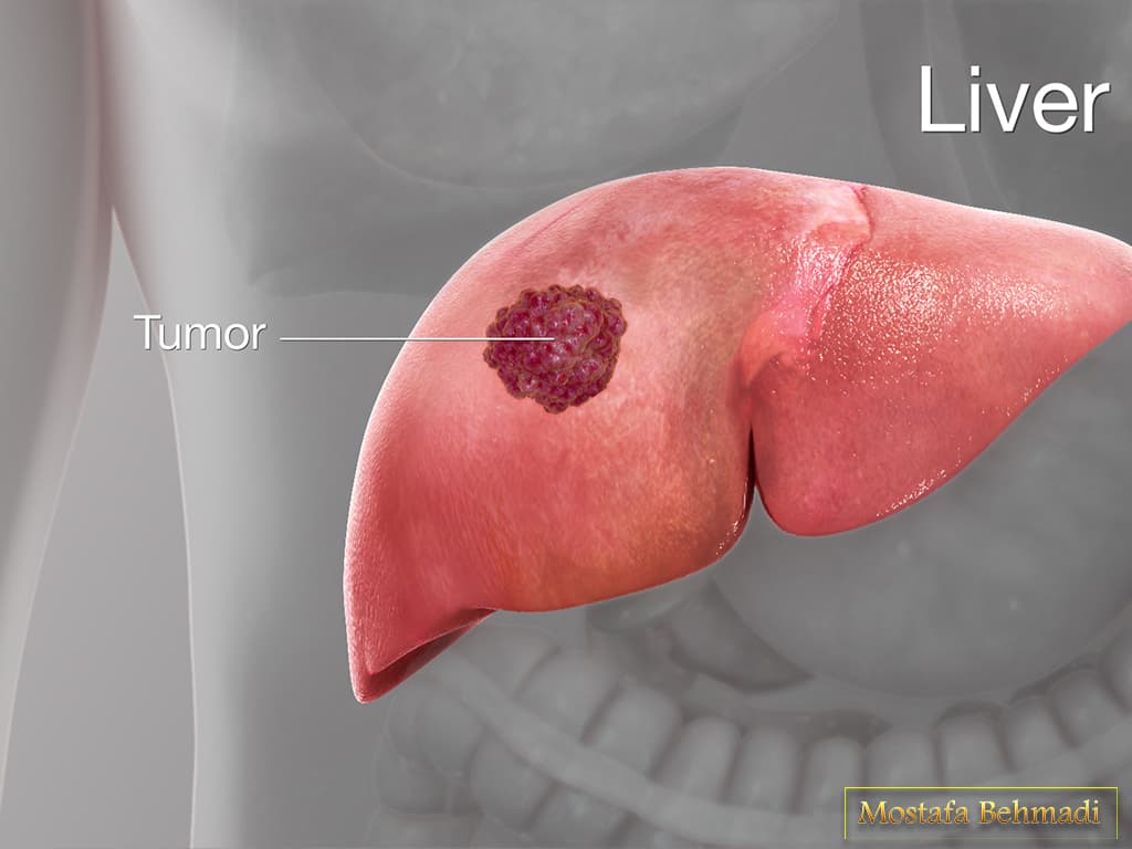 نشانه های سرطان کبد