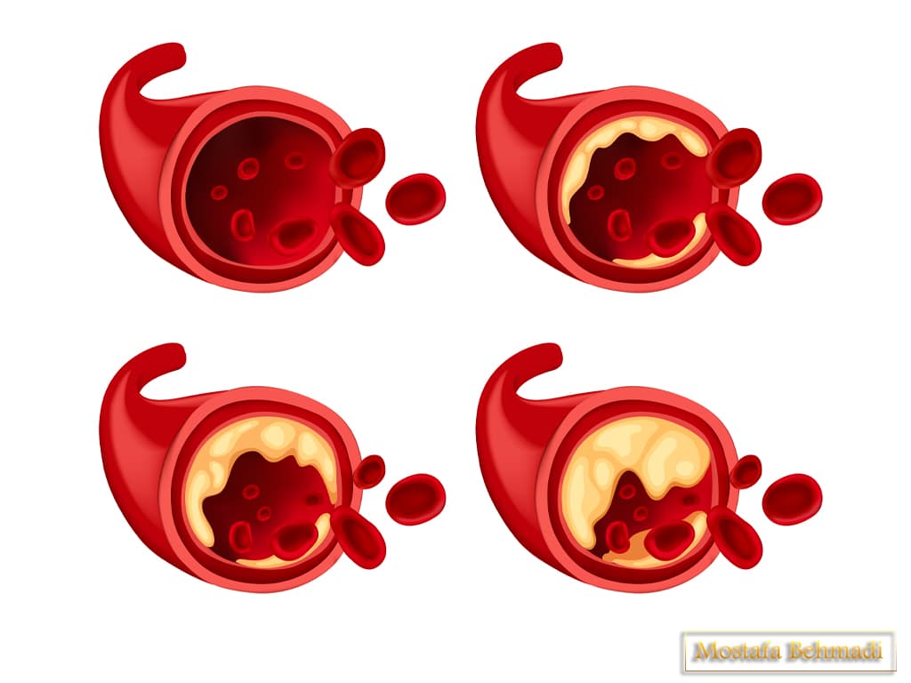 درمان سرطان خون سرطان خون خوش خیم
