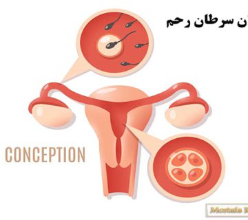 درمان سرطان رحم