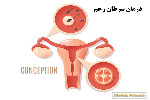درمان سرطان رحم