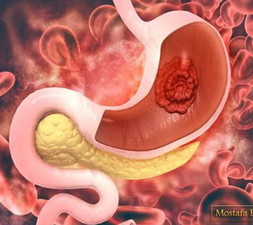 درمان سرطان معده