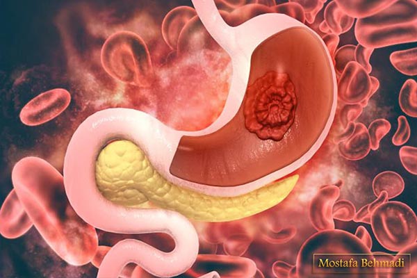 درمان سرطان معده