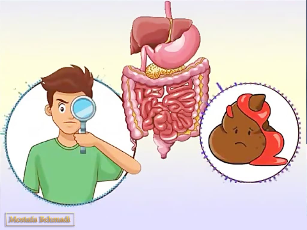 شرایط لازم برای آزمایش خون مخفی در مدفوع شرایط لازم برای آزمایش خون مخفی در مدفوع