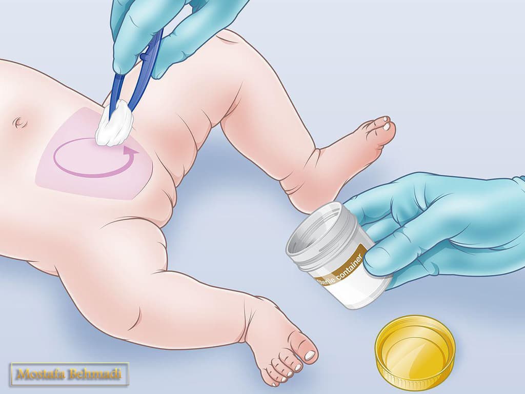 شرایط آزمایش عفونت ادراری در اطفال کشت ادرار اطفال